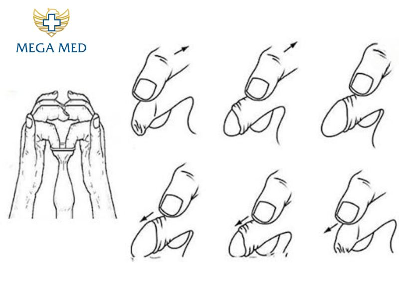 sau khi lột bao quy đầu nên làm gì